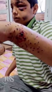 افزایش کورسازی در اعتراضات سراسری ۱۴۰۴؛ روایت بیمارستان فارابی از موج مجروحان چشمی