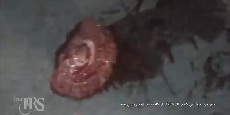 شلیک با سلاح سنگین به سر جوان معترض و متلاشی شدن مغز او در اعتراضات سراسری ۱۴۰۴